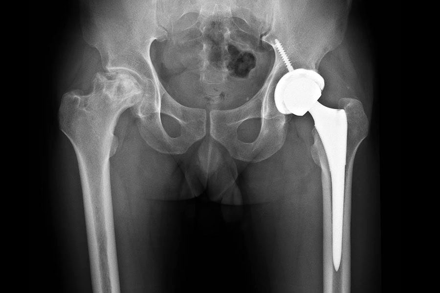 Hip-Replacement-Mr-Obakponovwe-Chichester
