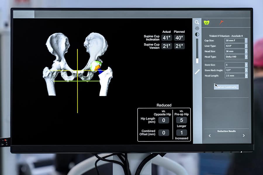 Complex-Hip-and-Knee-Joint-Replacement-Surgery