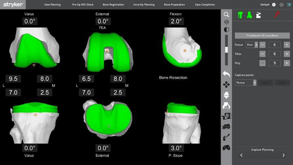 Knee replacement Mako